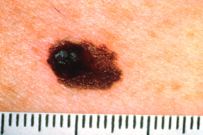 melanoma